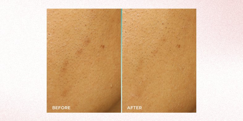 In Article Glowing Skin Tips 02 Exfoliating Peel